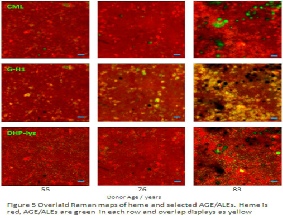 Heatmaps of a range of components and stressors in the filter tissue behind the retina, showing age related changes in distribution